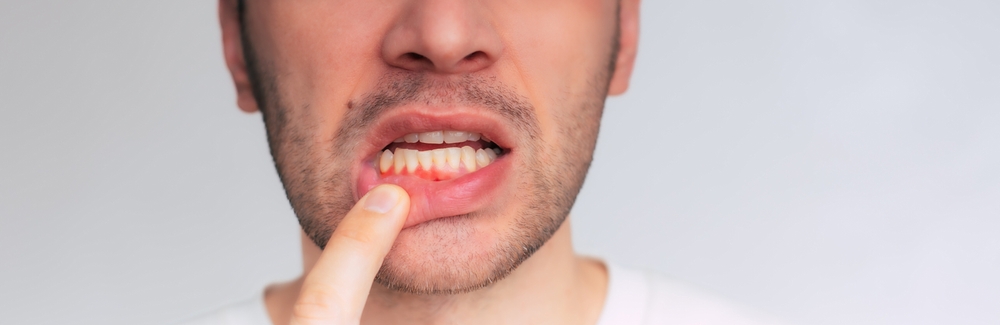 gum recession in leduc causes symptoms and treatment options