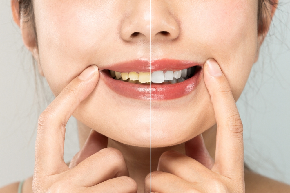 whats the fastest way to whiten yellow teeth