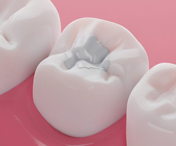 dental fillings in leduc