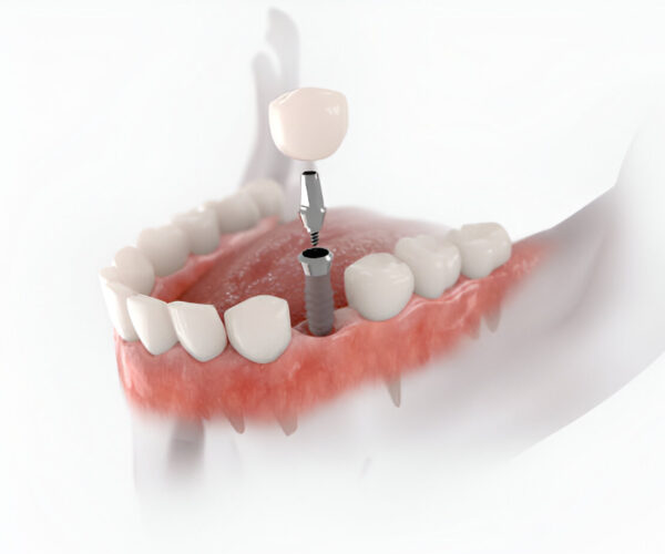 dental implants in leduc