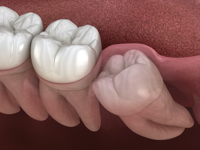 wisdom teeth removal in leduc