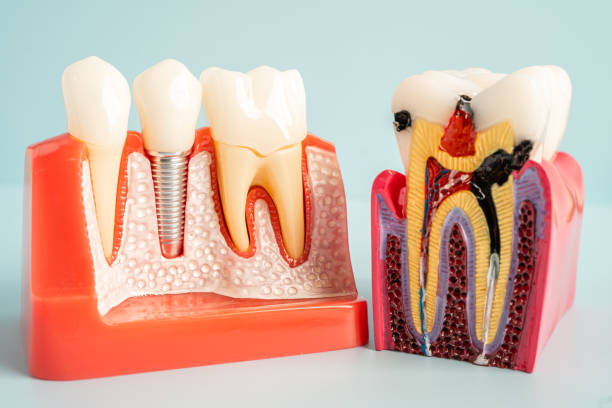 are dental implants better than root canals
