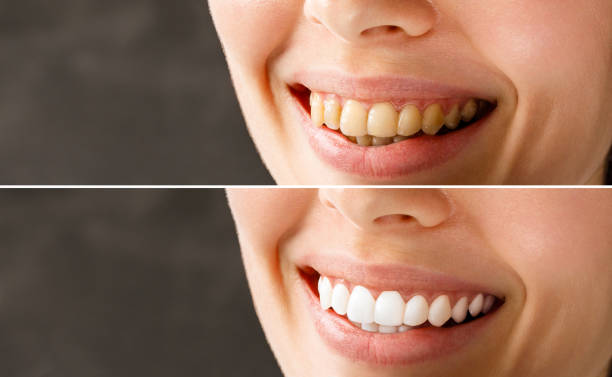 teeth whitening before and after what results can i expect