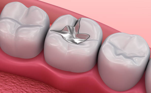 how a simple dental filling can save your tooth