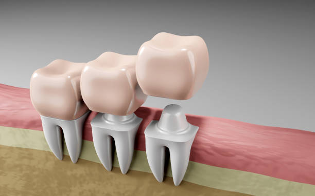 how crowns help preserve your natural teeth